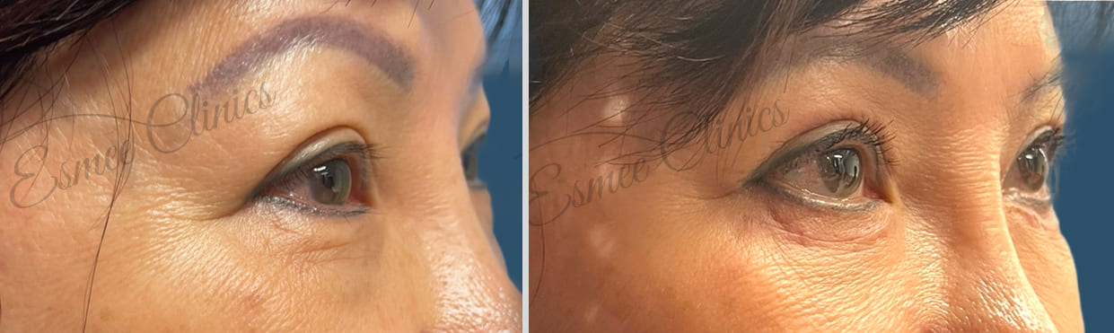 Before and After img